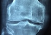 Osteoporose: Mit Bewegung die Knochen stärken