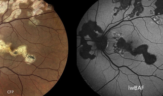 Vereinfachte Diagnose von Augenkrankheit