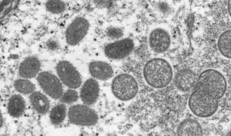 Sprunghafter Anstieg der Mpox-Infektionen im Kongo - WHO befrchtet Ausbreitung