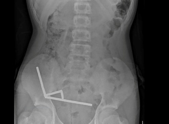 Neuseeland: Chirurgen entfernen bis zu 100 Magneten aus Gedärmen eines 13-Jährigen