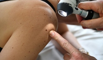 RKI: Etwa 517.800 Menschen erhielten 2023 Krebsdiagnose - Sterblichkeit rückläufig