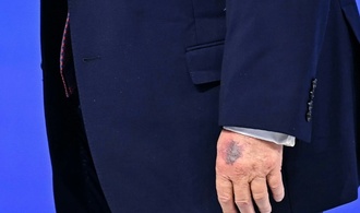 Davos: Deutlich sichtbarer Bluterguss an Trumps linker Hand