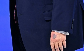 Davos: Deutlich sichtbarer Bluterguss an Trumps linker Hand