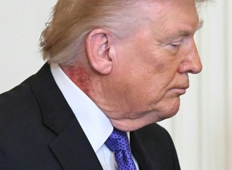 Roter Ausschlag an Trumps Hals sorgt für neue Spekulationen - Arzt nennt ''präventive'' Behandlung als