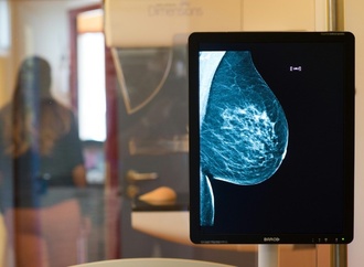 Mammografie: Altersgrenze für Brustkrebs-Früherkennung wird herabgesetzt